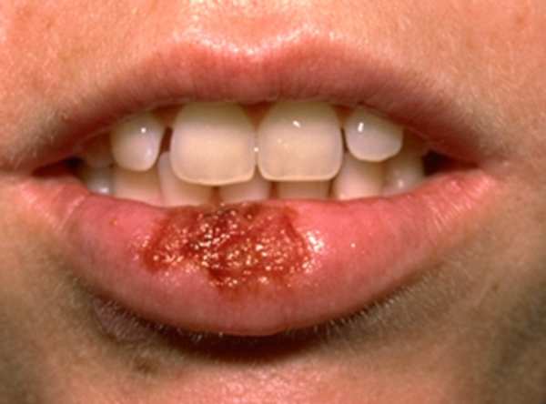 Herpes Zoster Picture Image on MedicineNet.com