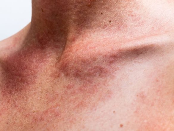 Soffri Di Dermatite Il Tuo Problema Potrebbe Essere L istamina Ecco I 