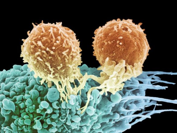 Linfoma A Grandi Cellule B Del Mediastino Si Guarisce