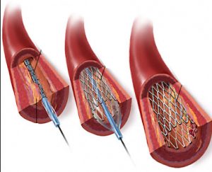 STENT CORONARICO