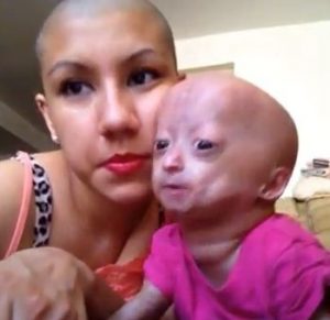 la piccola Adalia Rose Williams, una piccola star del web affetta da Progeria