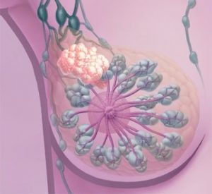 cancro al seno