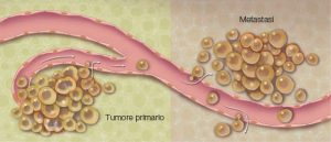 TUMORE PRIMARIO E METASTASI