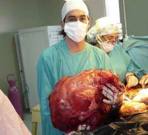 TUMORI: ARGENTINA; ESTRATTO DA UTERO SARCOMA RECORD DI 23 KG