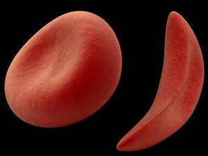 anemia falciforme