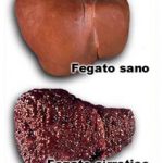 CIRROSI EPATICA OK - Copia