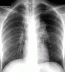 TUBERCOLOSI 2 - Copia