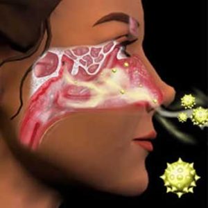 CONGIUNTIVITE ALLERGICA