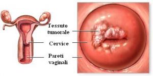TUMORE CERVICE