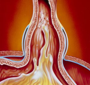 Art of gastro-oesophageal reflux in hiatus hernia