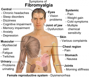 FIBROMIALGIA