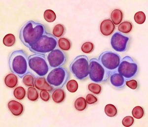 leucemia