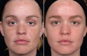 MELASMA 1