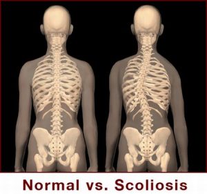 scoliosi