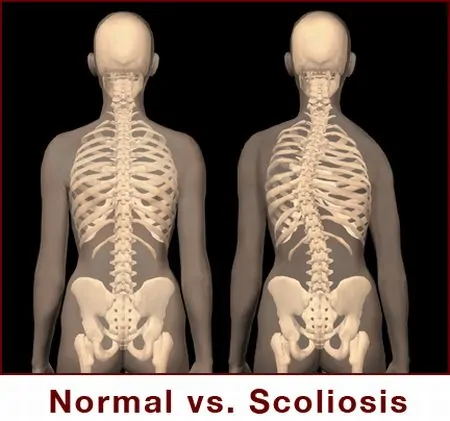 scoliosi
