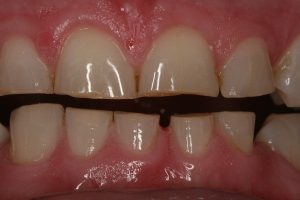 USURA DENTALE 2