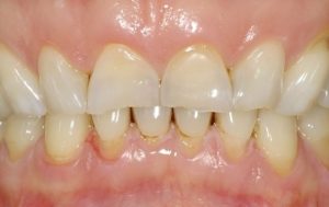USURA DENTALE