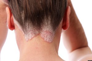 ECZEMA 2