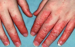 eczema