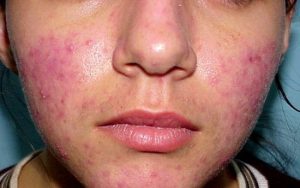 acne-rosacea-pustole-con-pus