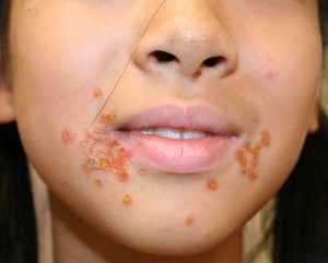 IMPETIGINE 2