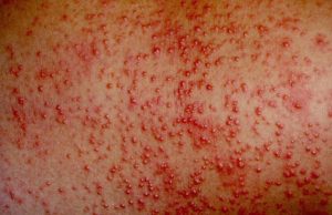 MILIARIA COP