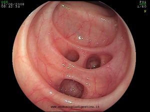 DIVERTICOLI