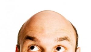 calvizie capelli