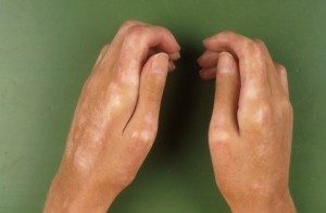 scleroderma