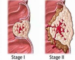 Diagnosi-Precoce-Cancro-Ovarico