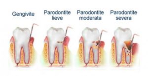 Parodontite