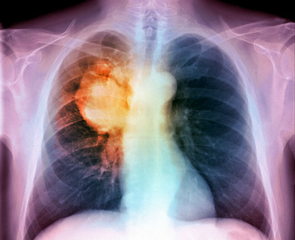cancro al polmone