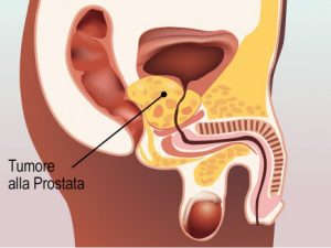 prostata ingrossata puo essere tumore