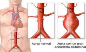 aneurisma_aorta2