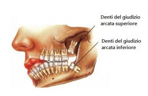 denti-del-giudizio