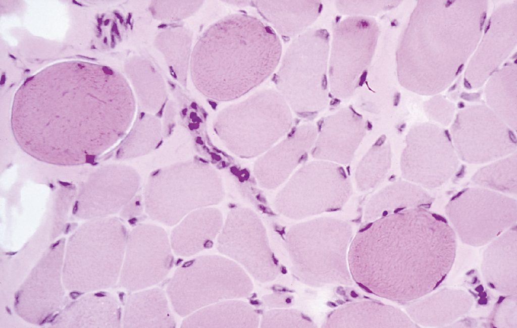 distrofia muscolare di duchenne
