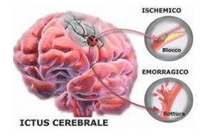 ictus_ischemico_emorragico_73611