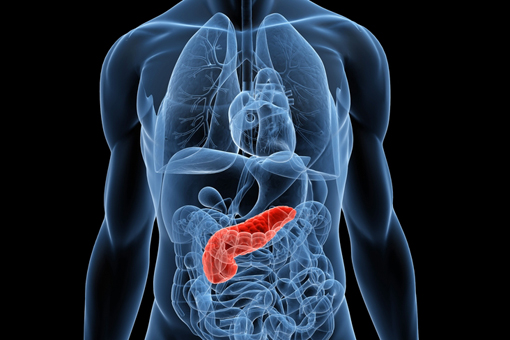 tumore pancreas