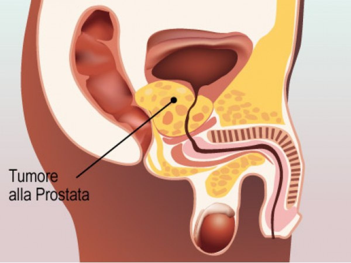 tumore prostata: sintomi