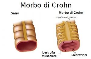 morbo-di-Crohn-500x325