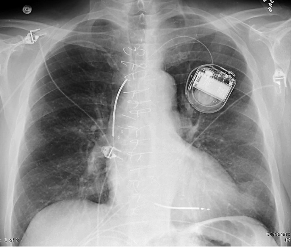 pacemaker