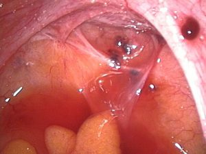ENDOMETRIOSI COP