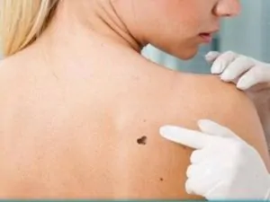 MELANOMA