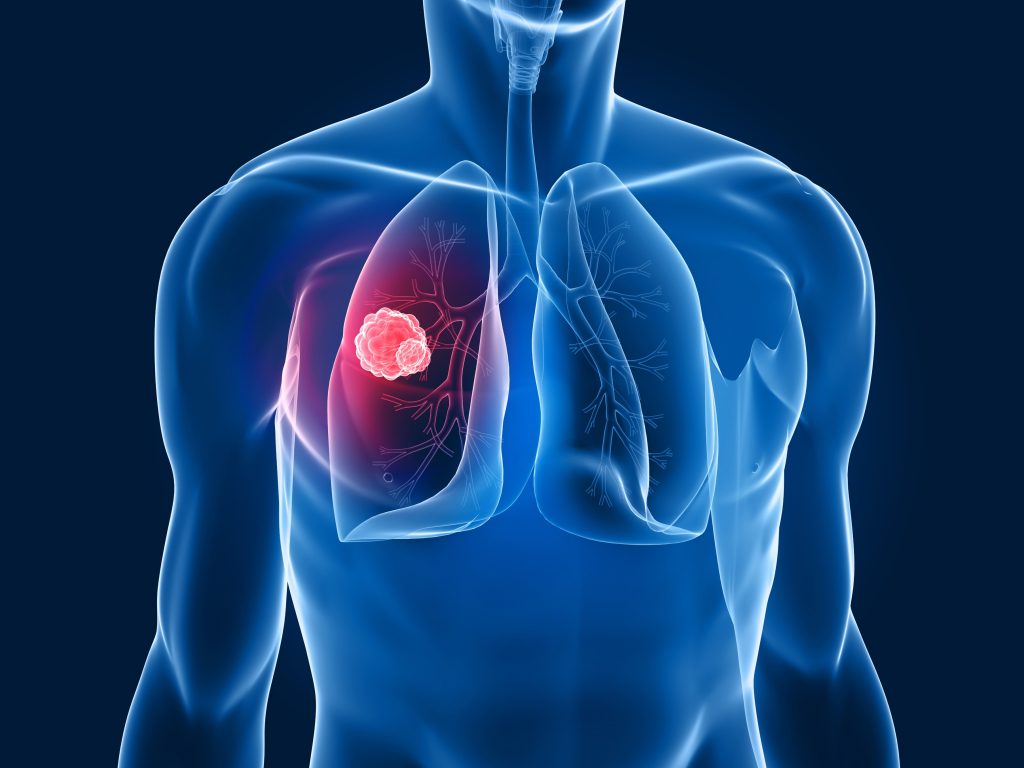 tumore polmone