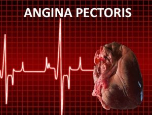 ANGINA 3
