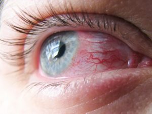 CONGIUNTIVITE ALLERGICA 1