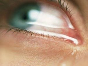 CONGIUNTIVITE ALLERGICA 2