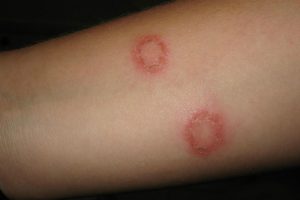 IMPETIGINE 2017 1