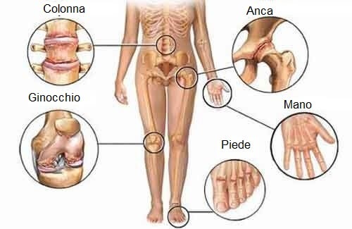 artralgia sintomi