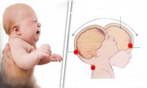 Shaken Baby Syndrome neoneti scossi